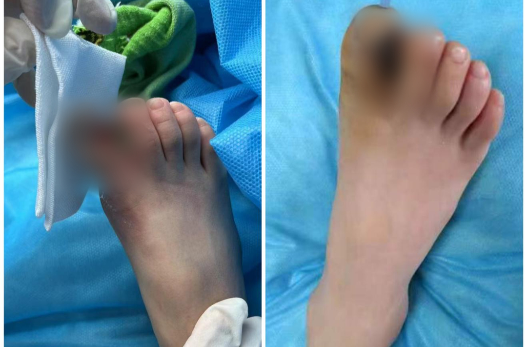 南华医院手足外科“镜下绣花”，为8岁患儿保住足趾